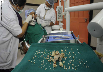 جراحون يقتلعون 232 سنًا من فم هندي